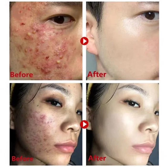 Acne Cream Treat Pimple Korean Clean Skin Care - Image 3