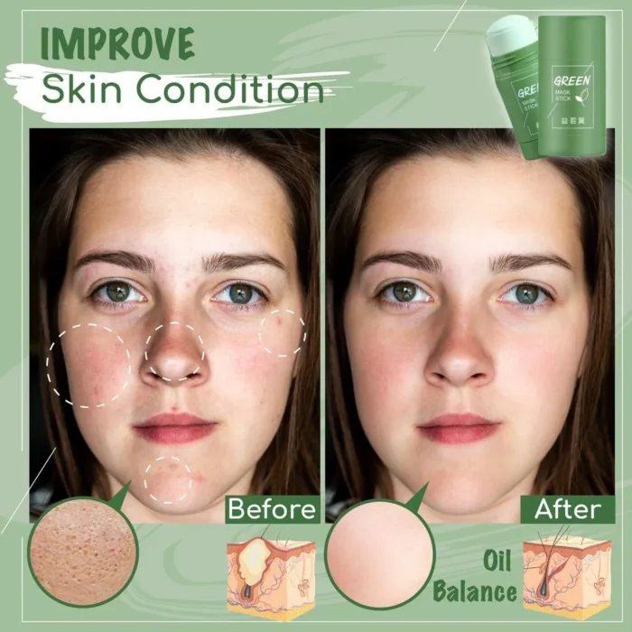 Acne Cream Treat Pimple Korean Clean Skin Care - Image 2